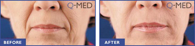 Restylane Before and After Image 1