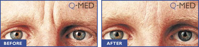 Botox Before and After Image 1